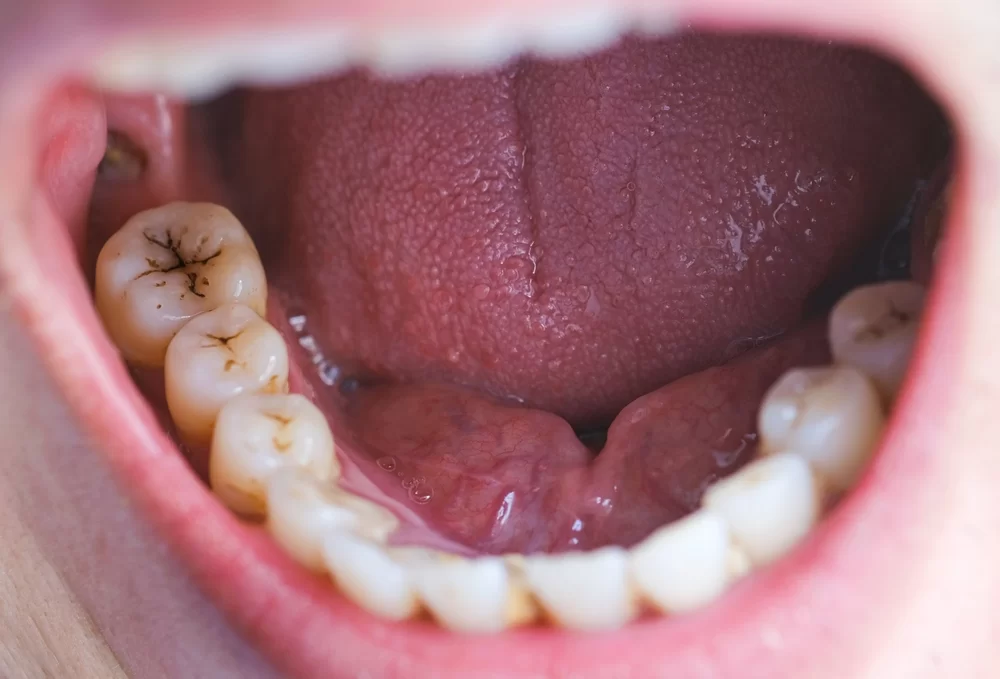 Tratamento de Cárie Dentária