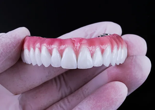 Caso de Sucesso - Prótese Fixa sobre Implantes